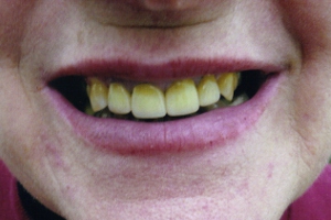 After PVC Crowns