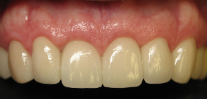 After Esthetic Crown Lengthening and Crowns