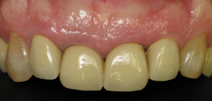 Before Esthetic Crown Lengthening and Crowns