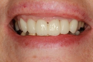 After Biomimetic Crowns