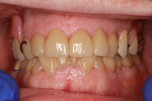 After Ceramic Crowns and partial denture