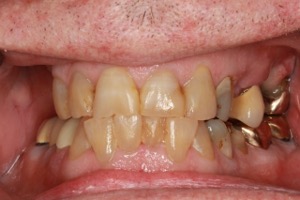 Before Ceramic Crowns and partial denture