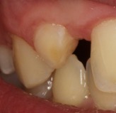 Before additive dentistry