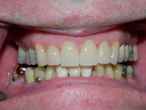 After Anterior Crowns