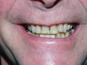 Before Anterior Crowns